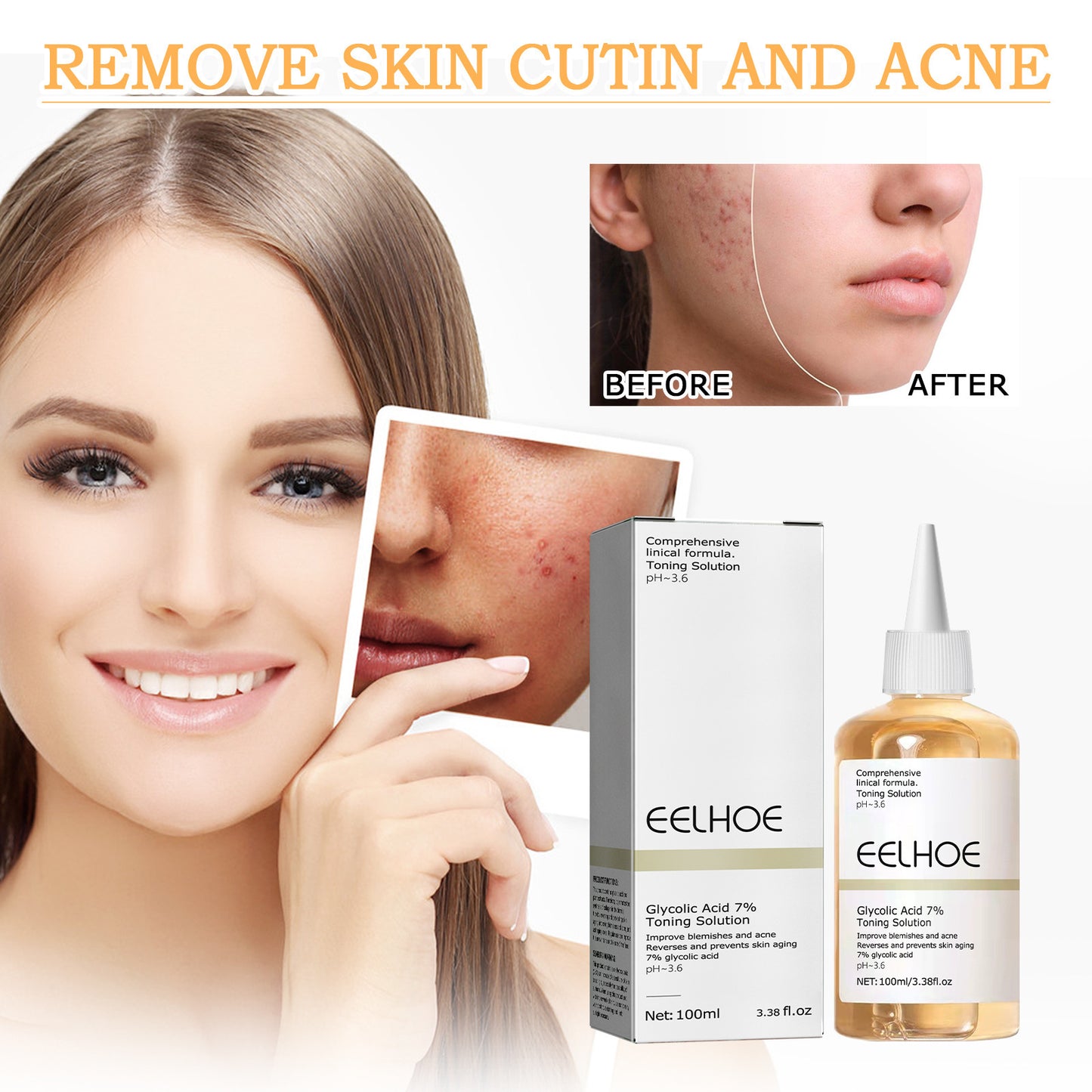 Glycolic Acid 7 Acne Removing Solution
